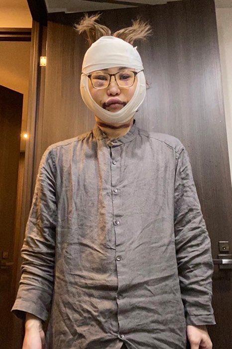 日本1米5小哥砸1600万疯狂整容增高！断骨惨烈过程吓傻网友