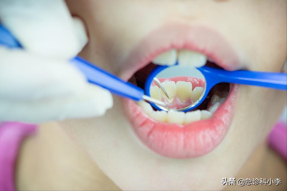 牙缝间的牙结石怎么清除,牙缝里的牙结石怎么去除