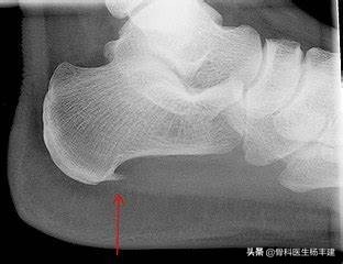 中老年脚后跟疼可以艾灸吗,中老年妇女脚后跟疼痛如何治疗