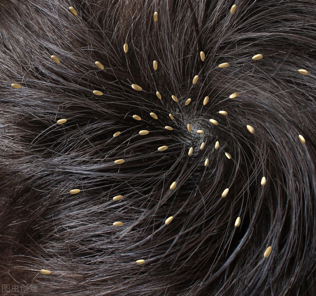 20年前常见的虱子,几十年前的农村几乎身上都有虱子