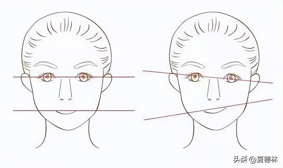 下颌角手术怎么避免后遗症,下颌角手术前要准备什么