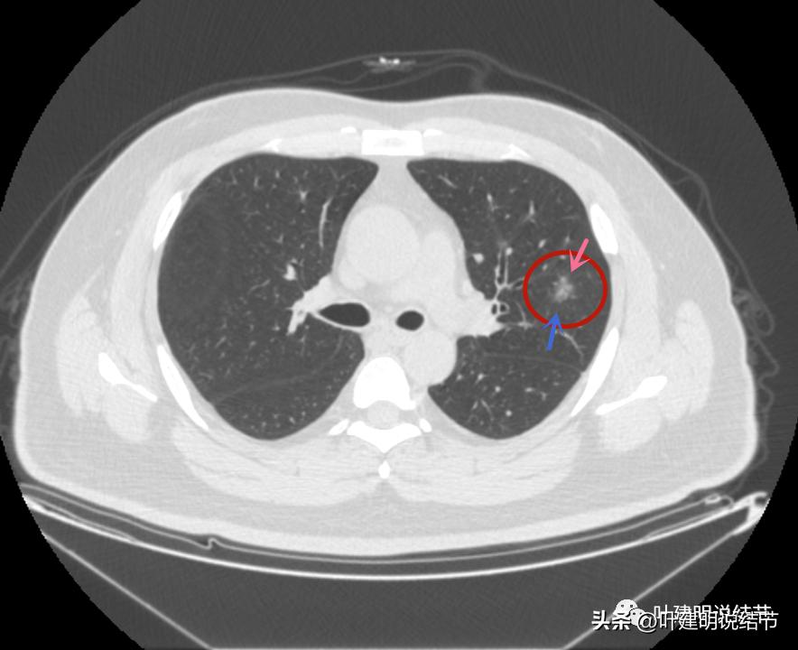 如何判断肺磨玻璃结节是高危结节,肺上有混合磨玻璃结节要注意什么