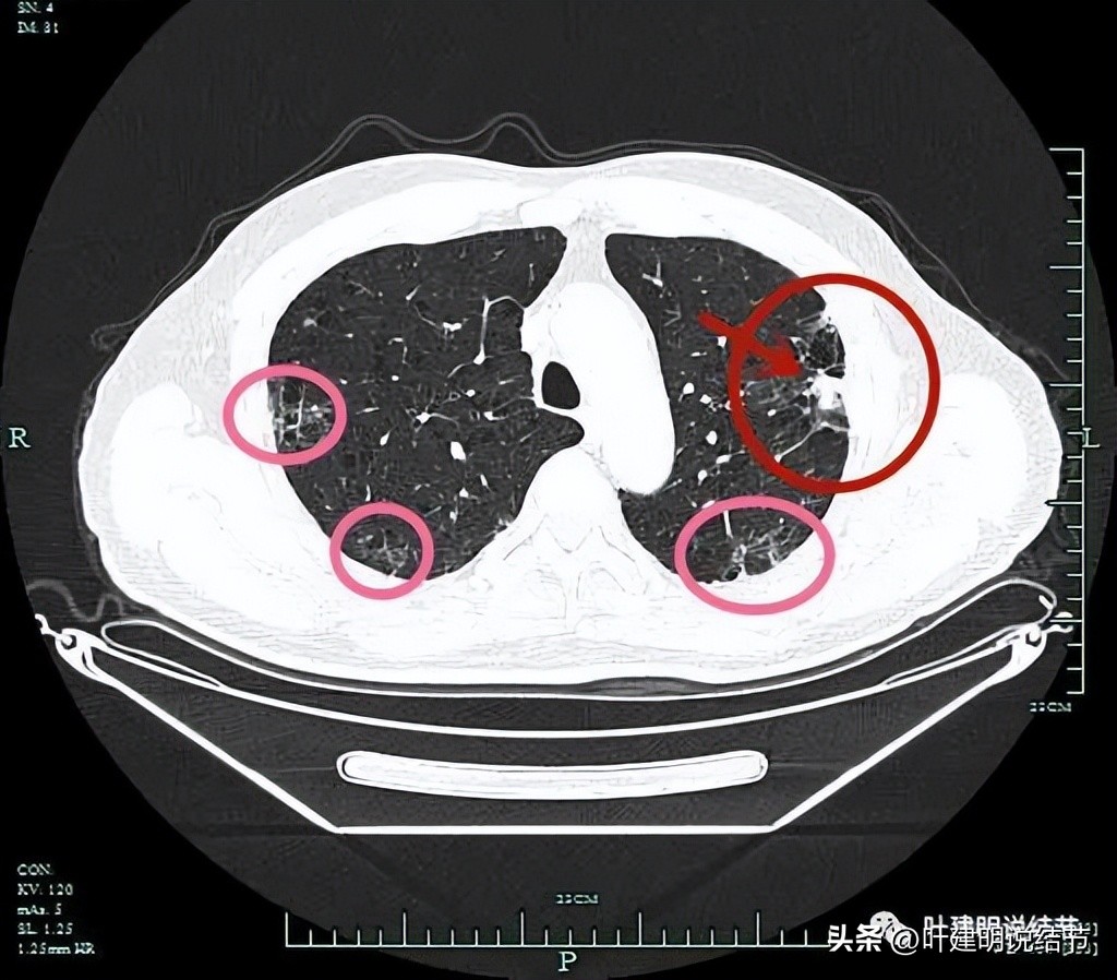 pet判断淋巴结转移,petct判断癌有没有转移准确吗