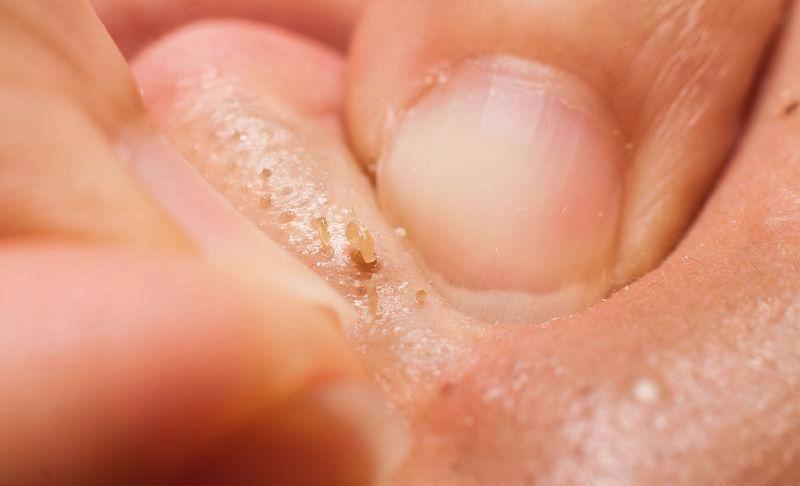 毛孔堵塞毛孔发黑怎样清理,毛孔长螨虫堵塞毛孔怎么办