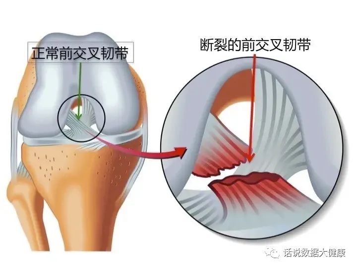 膝关节韧带撕裂保守治疗能恢复吗,膝关节韧带损伤和撕裂