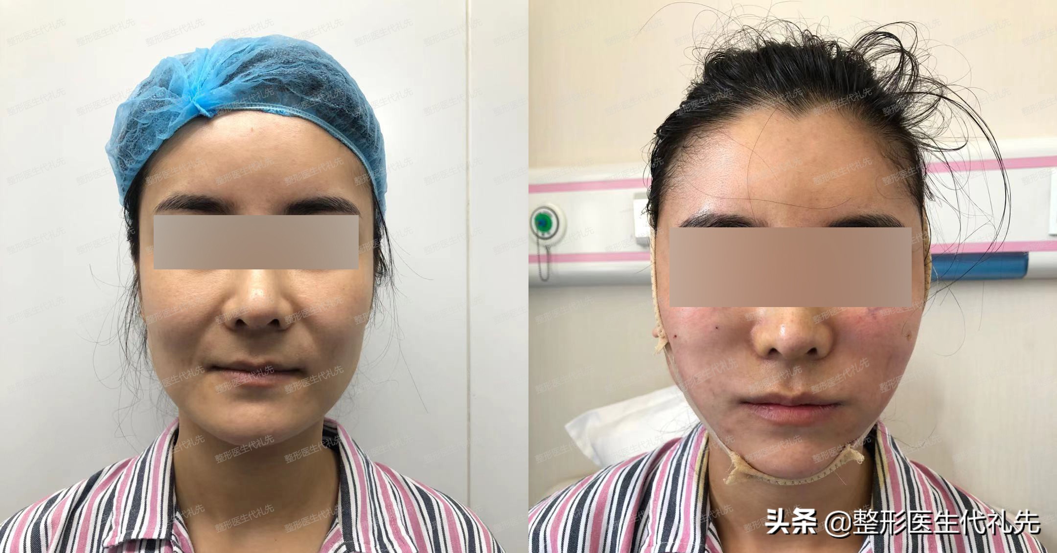 去法令纹现在最有效的方法是什么,去除法令纹的最有效的方法有哪些