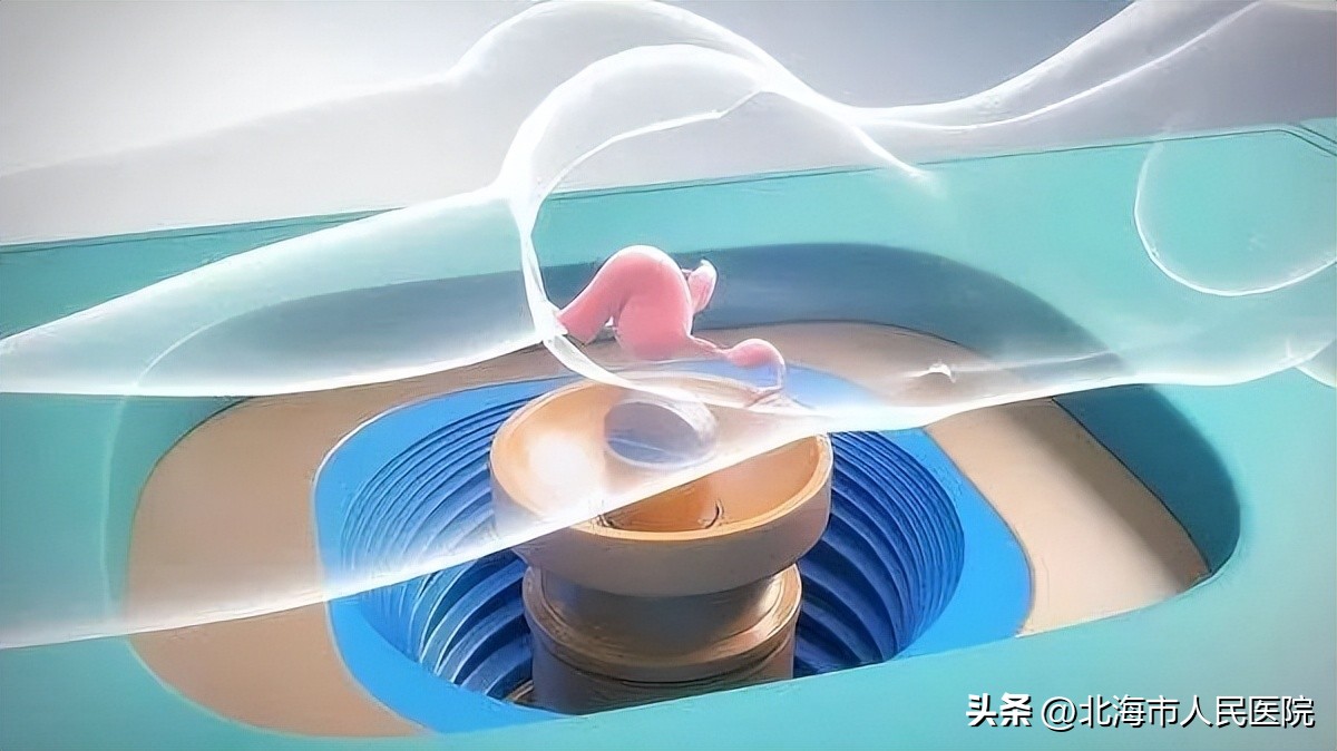 广西哪家医院引进了聚焦超声治疗,市人民医院入选首批协同医院