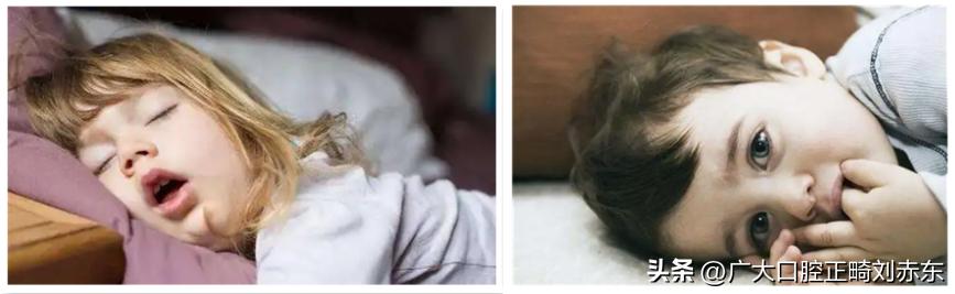 反颌属于什么病,牙反颌是什么原因