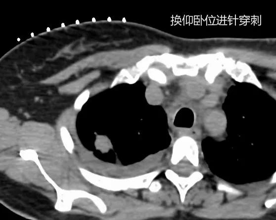肺癌egfr阳性吃靶向药能活几年,肺癌靶向治疗基因检测egfr