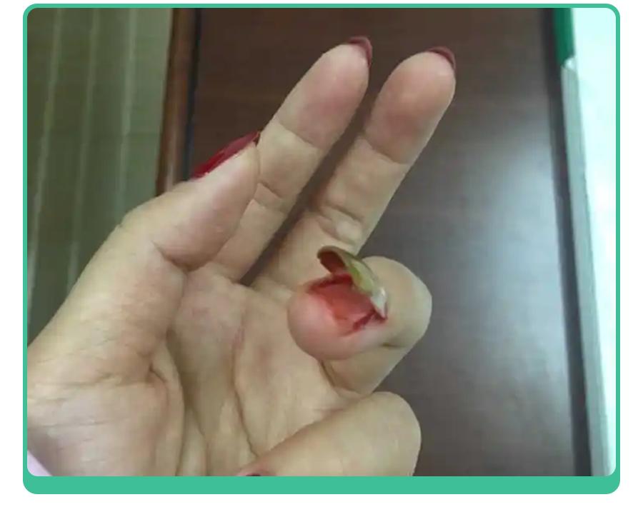 小孩指甲凹陷变黑有坑是什么原因,小孩指甲有白点和细纹是怎么回事