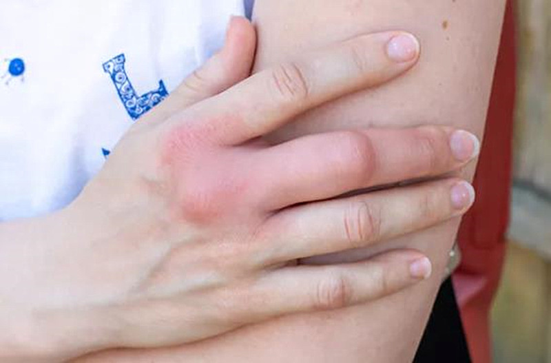 手指肿胀，弯曲就痛，指甲变脆，容易被误诊的银屑病关节炎