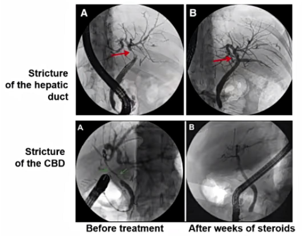 贾继东教授乙肝治愈主要药物,肝病专家贾继东抖音号