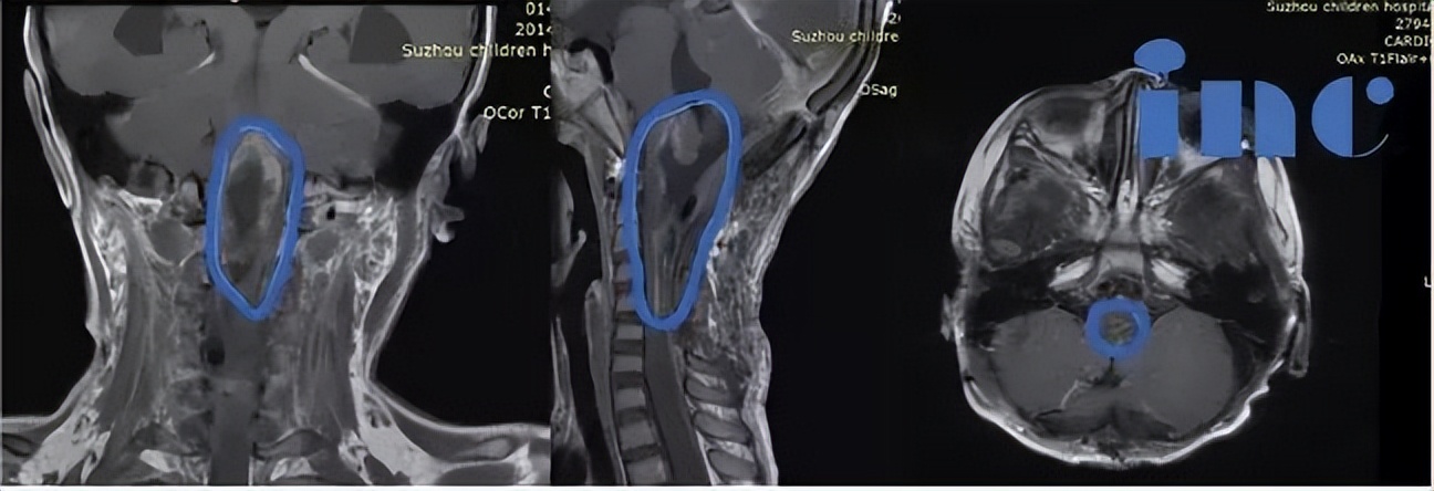 小儿脑瘤并非都治愈无望！家长关心的热点问题汇总答疑
