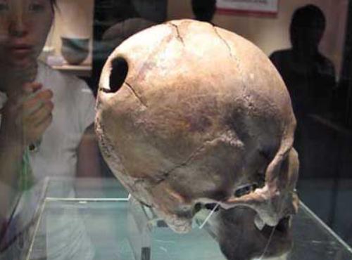 给脑壳钻孔、用吸血虫治病，这些古代治疗手段吓到我了