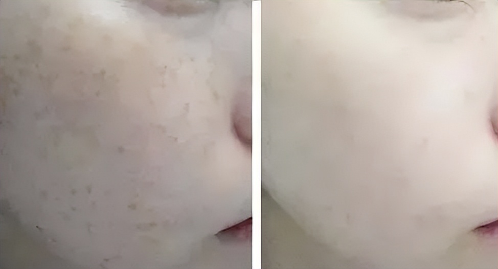 韩国东星小黑瓶祛斑霜，​韩国东星制药60年口碑企业出品！