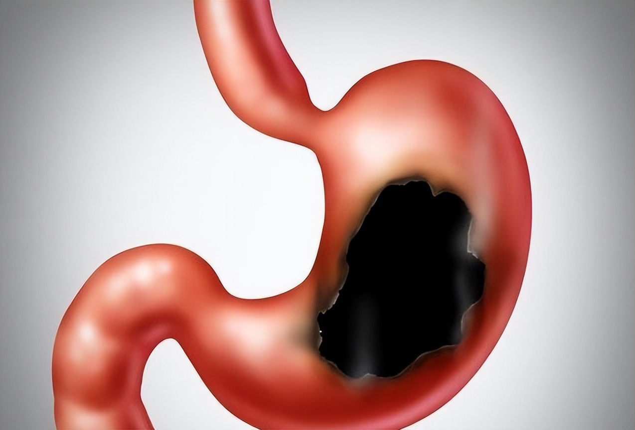 两个胃溃疡信号不重视，小心癌变！中医两味药巧治胃溃疡