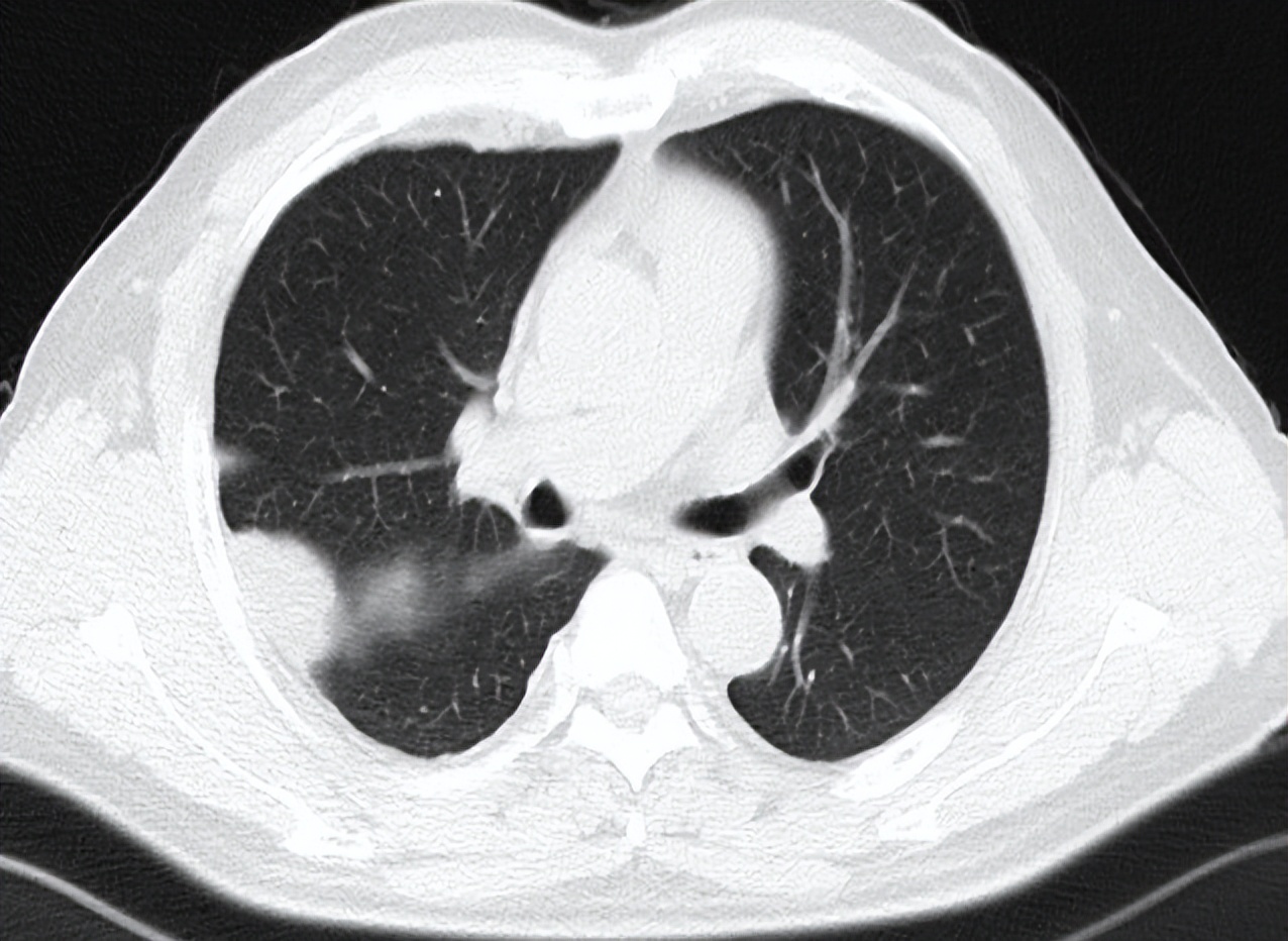 海南首例恶性胸膜间皮瘤,胸膜间皮瘤生存5年算治愈吗