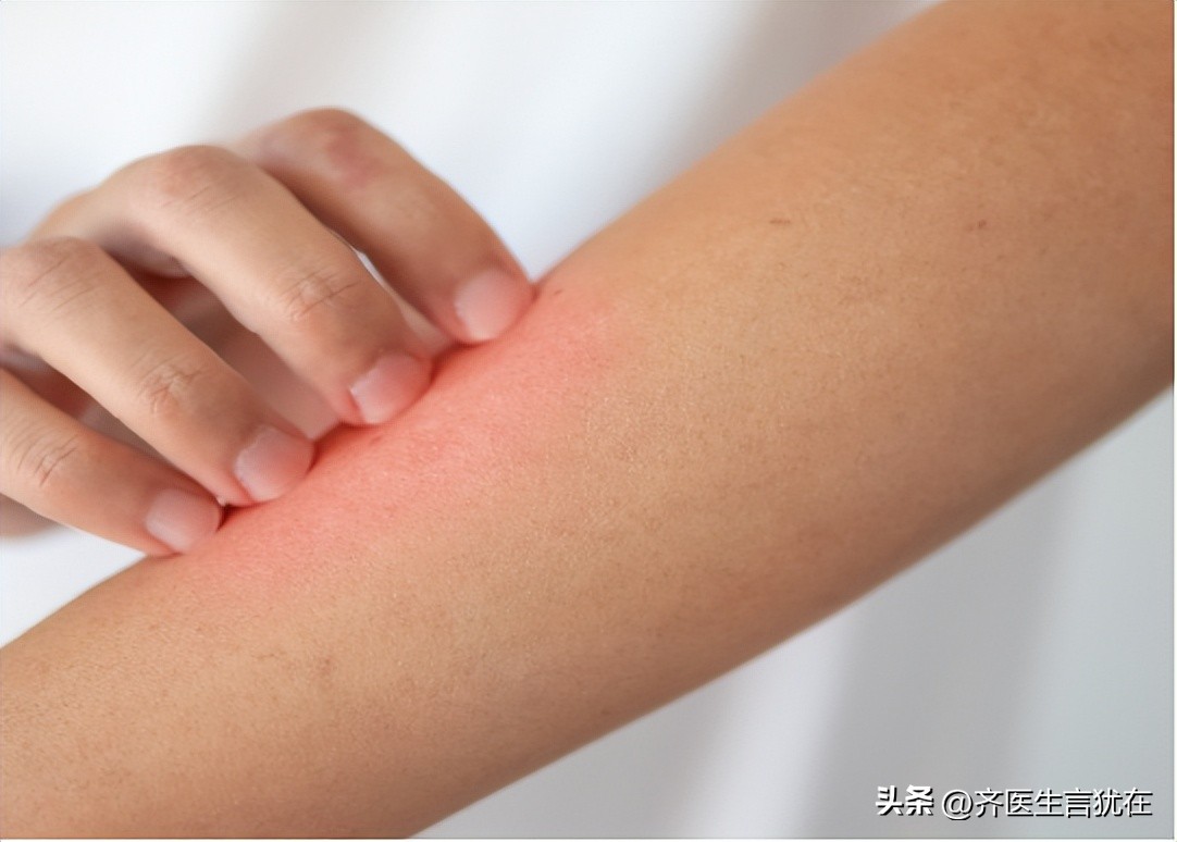 过期了的沐浴露过敏了怎么办,皮肤过敏能用沐浴露或者香皂吗