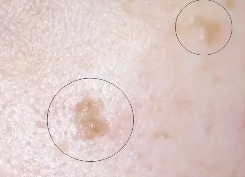 皮肤表面的小肉球是什么,皮肤上的小疙瘩小肉球