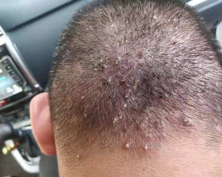 头皮得了毛囊炎怎么治疗效果最佳,头皮出现毛囊炎怎么根治