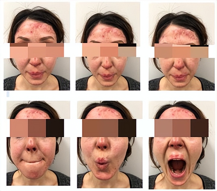 重度烧伤80%皮肤修复,皮肤烧伤的女孩后续