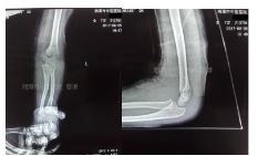 肱骨骨折取钢板怎样恢复,肱骨近端骨折切开复位内固定术