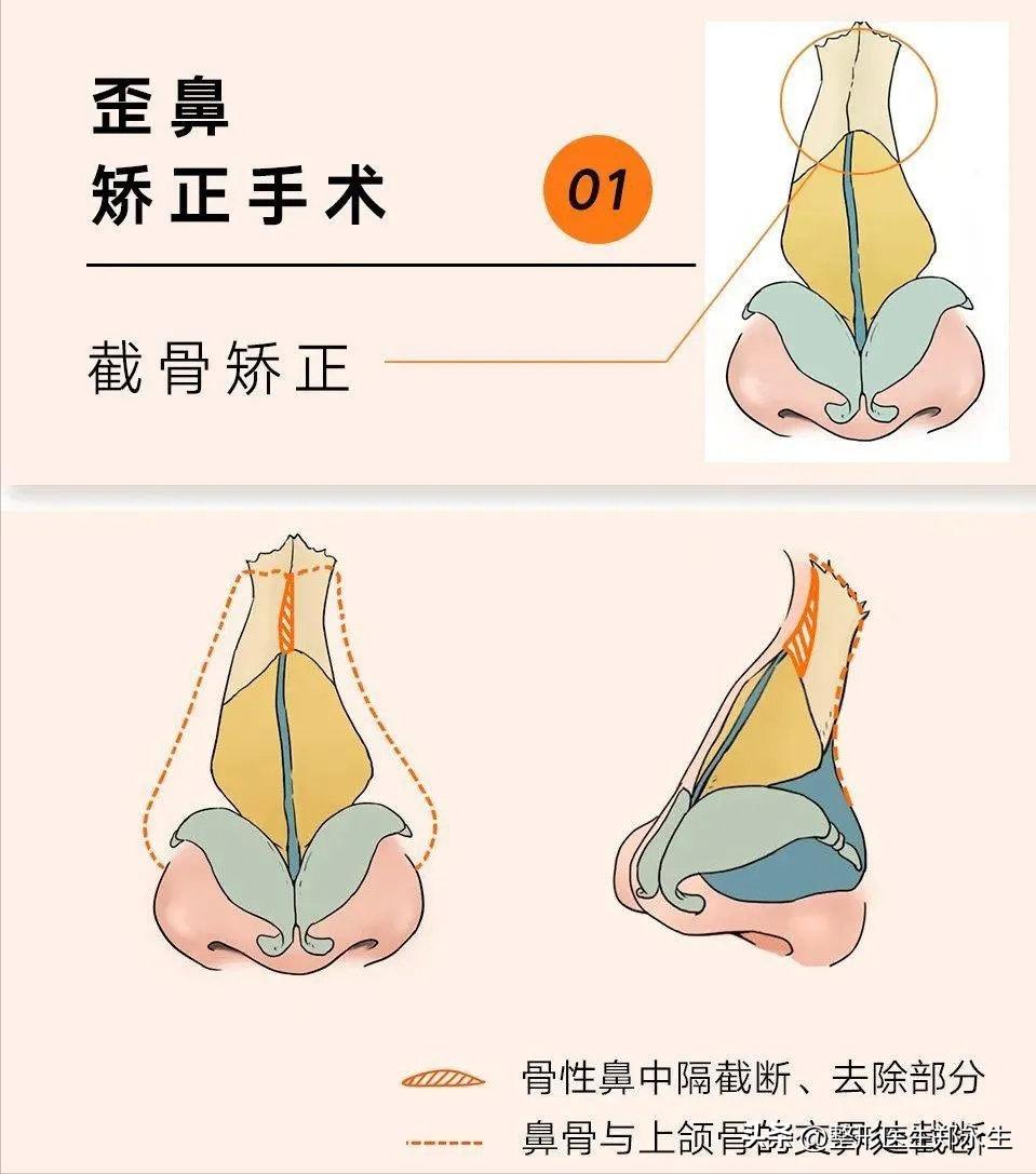 歪鼻是什么原因引起的,歪鼻歪鼻