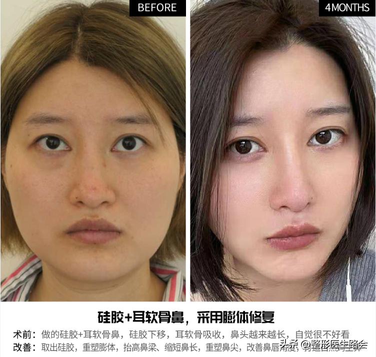 假体隆鼻7天发现歪了可以调整吗,假体隆鼻20年后变化