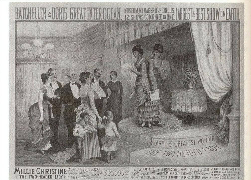 连体双胞胎姐妹的悲惨人生,双胞胎姐妹一个死亡后续