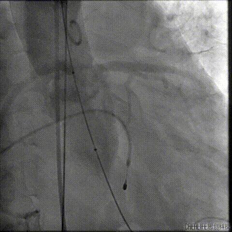 病例回顾与分享,腹膜后血肿介入治疗