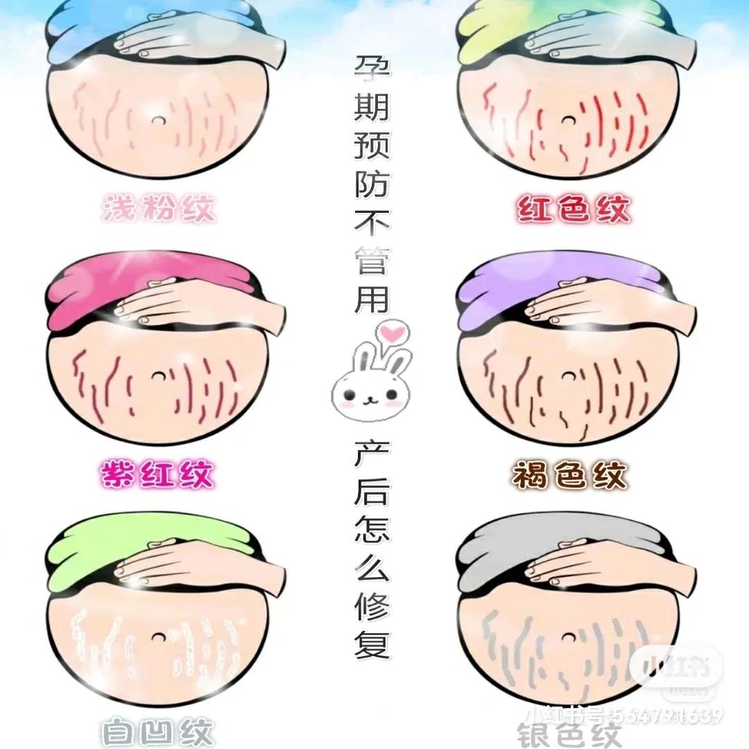 怀孕胸上长妊娠纹可以涂妊娠油么,强生婴儿油可以预防妊娠纹吗
