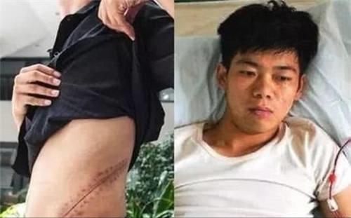 切除一个肾对男性的影响,切除一个肾脏可怕吗