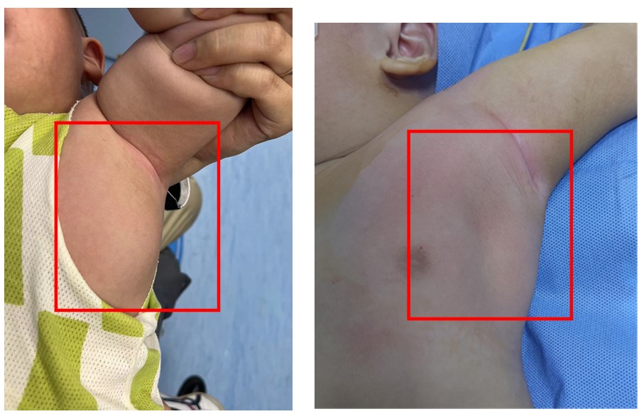 儿童腋下淋巴管瘤介入微创治疗病例