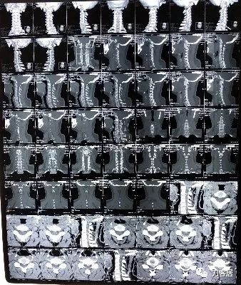 颈椎突出并椎管狭窄能正骨吗,颈椎间盘突出无症状