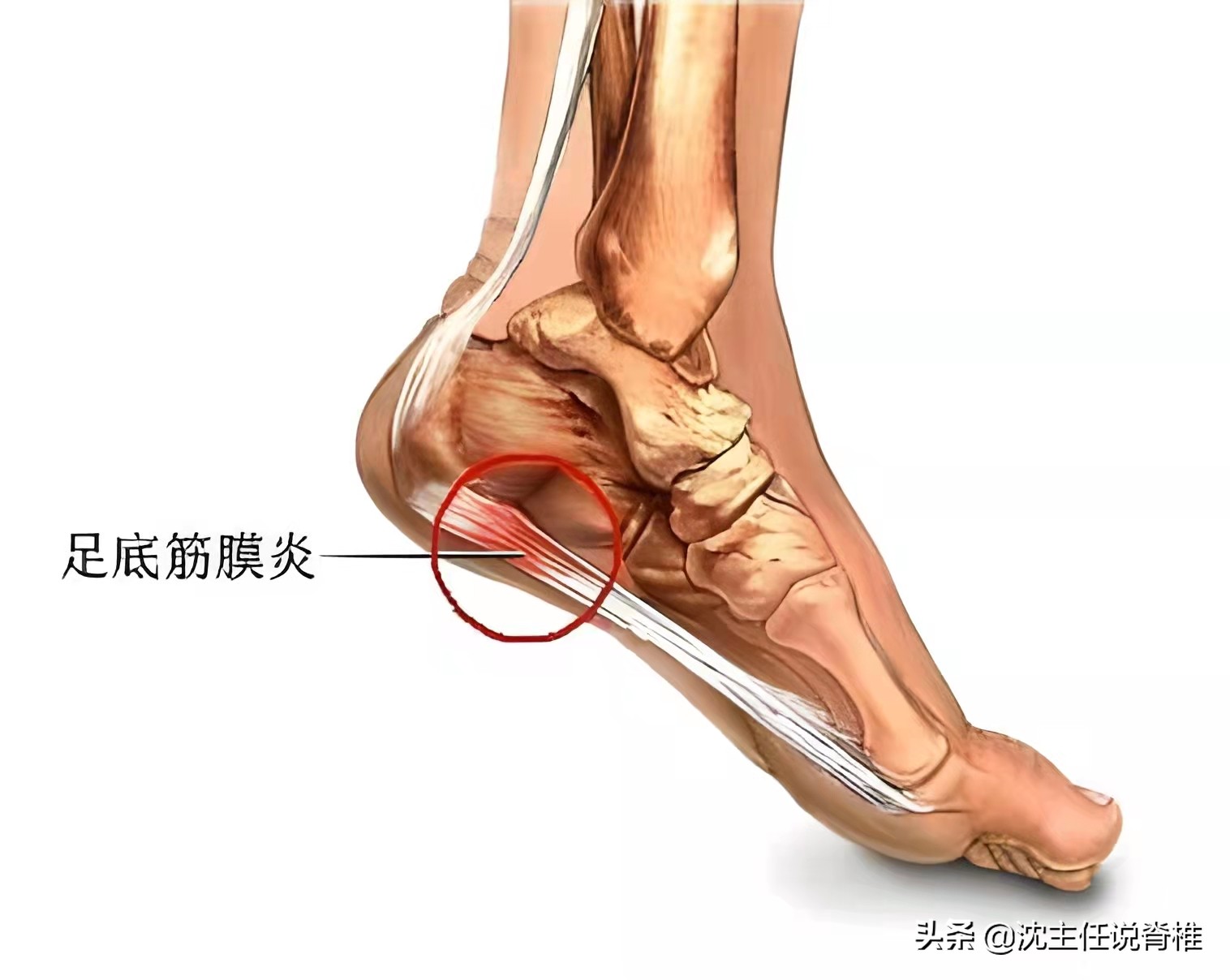 脚后跟痛是什么原因怎么锻炼,10岁小孩脚后跟痛原因及治疗方法