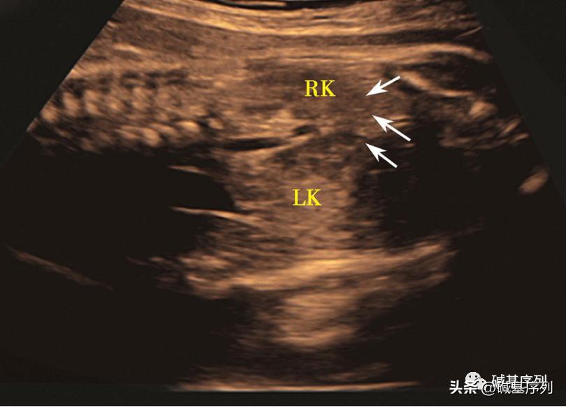 马蹄肾容易发病吗,马蹄肾发病率是多少