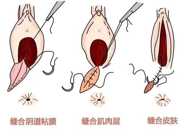 顺产如何防止侧切和撕裂,顺产妈妈最怕什么