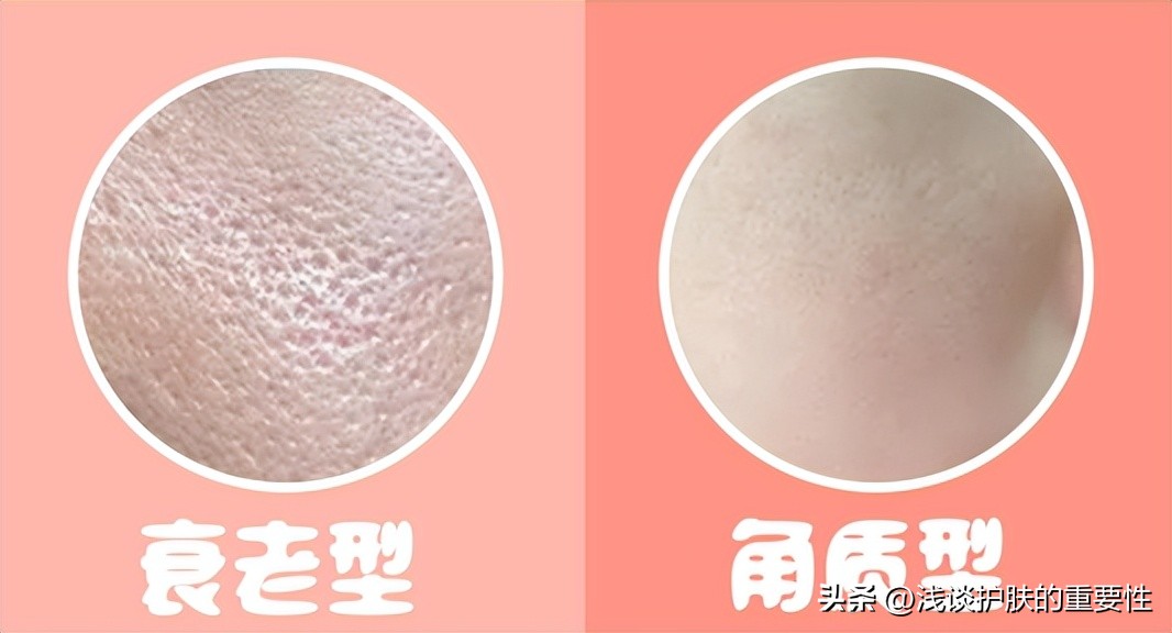 小方法解决毛孔粗大问题,佰花方能收缩毛孔吗