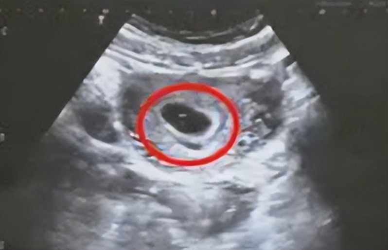 hcg2万多孕囊小,hcg多少值就能排除空孕囊