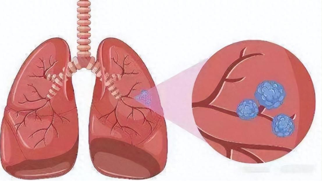 高温治疗是否可以杀死癌细胞,高温杀死癌细胞吗是真的吗