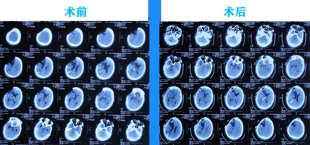 脑动脉瘤破裂手术后有脑水肿,动脉瘤开颅夹闭术出血