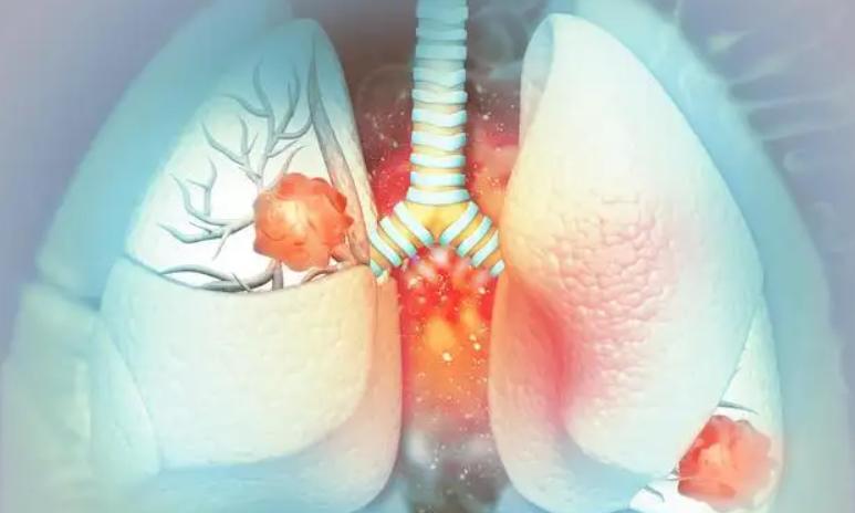 牛奶是肺结节“加速器”？忠告：这4类食物，肺结节患者需节制