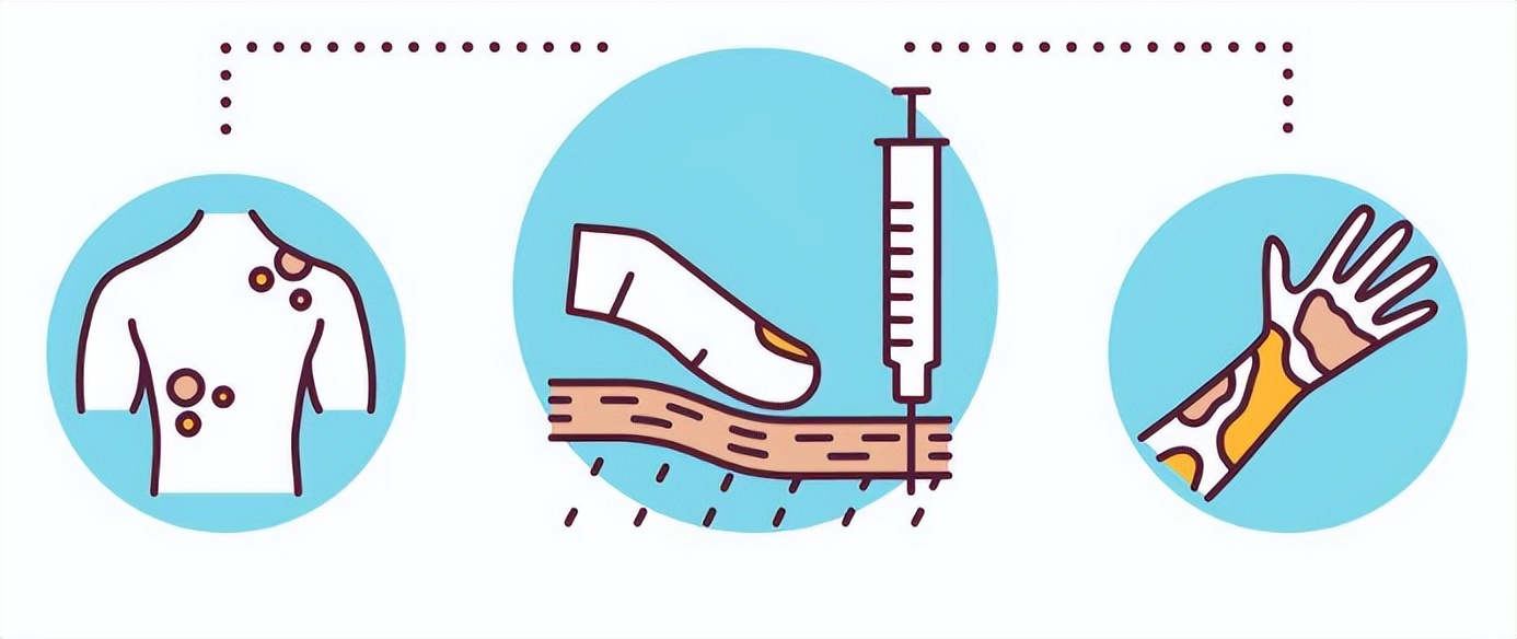 得了很严重的褥疮老人能活多久,老人得了褥疮可以吃鸡蛋吗