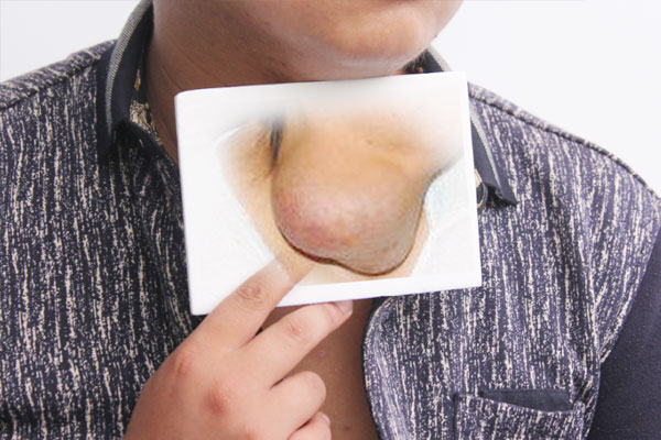 囊肿到底是什么病,囊肿属于炎症还是肿瘤