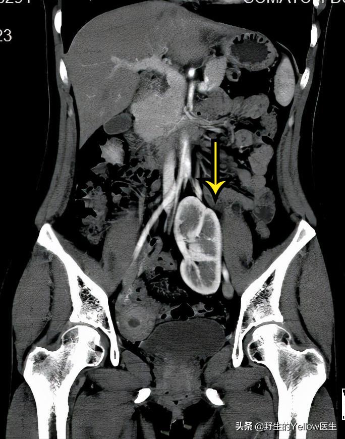 女性腹股沟长个包是怎么回事,姨妈期腹股沟有小疙瘩是什么