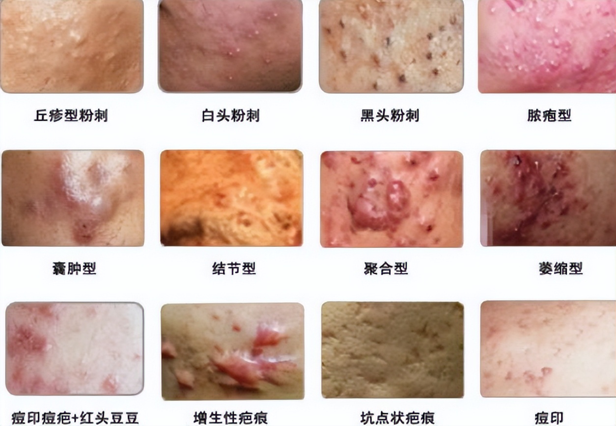 青春痘的预防和治疗方法,严重的青春痘治疗方法