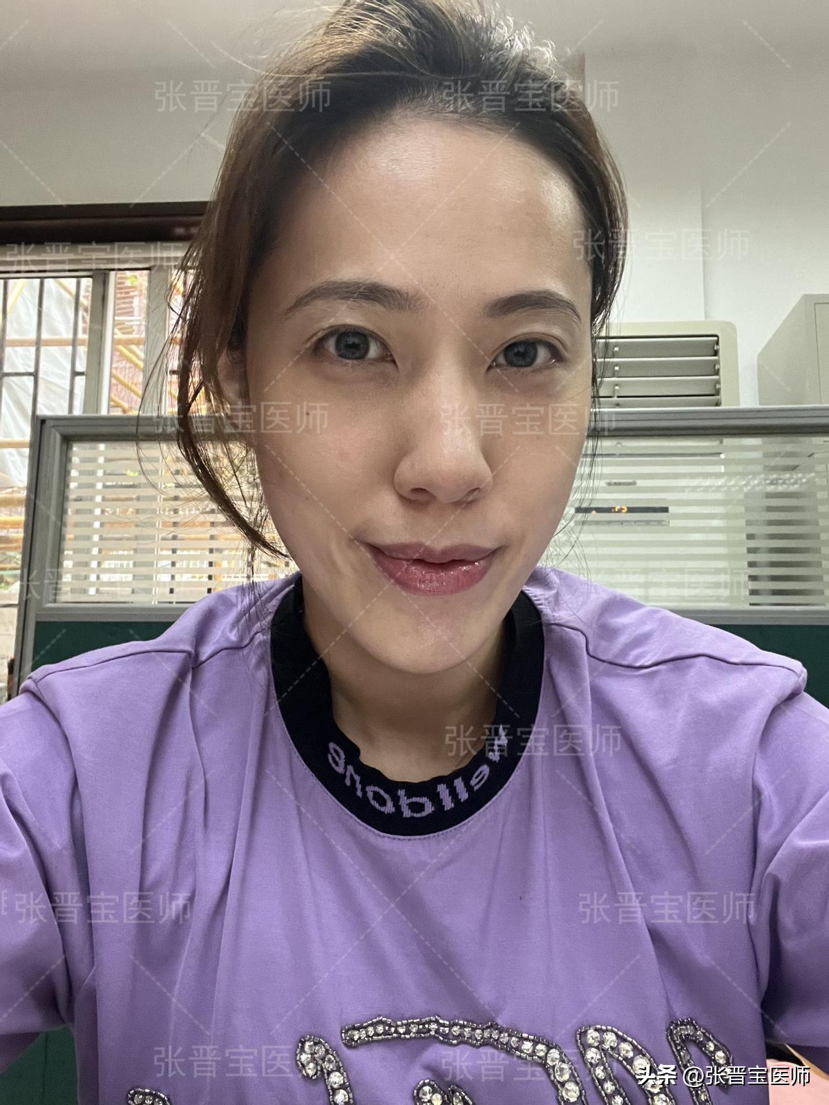 44岁女做眼袋切除适合吗,眼袋手术28岁