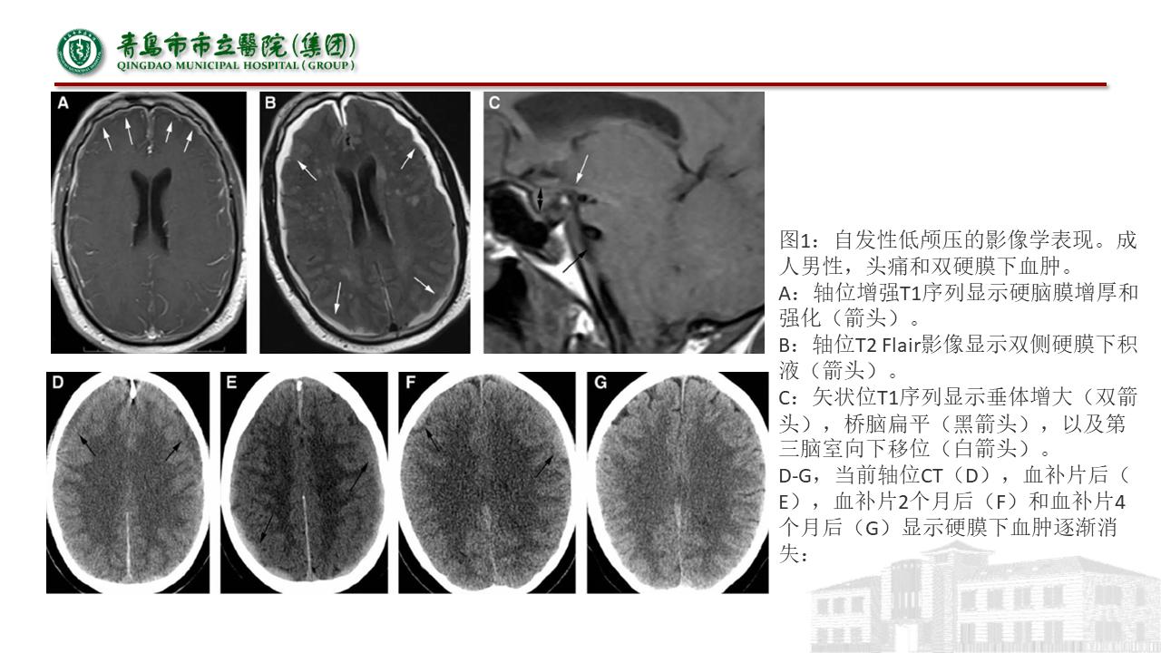 低颅压综合征耳闷,低颅压综合征吃什么药