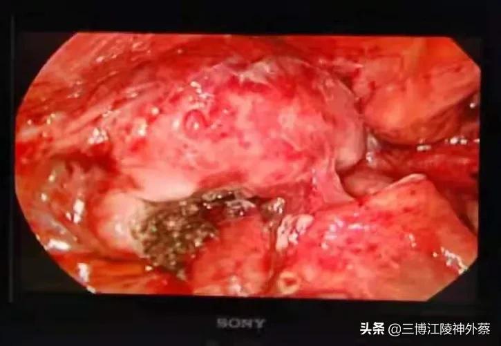 卵巢囊肿蒂扭转不能超过多长时间,左下腹隐痛卵巢囊肿