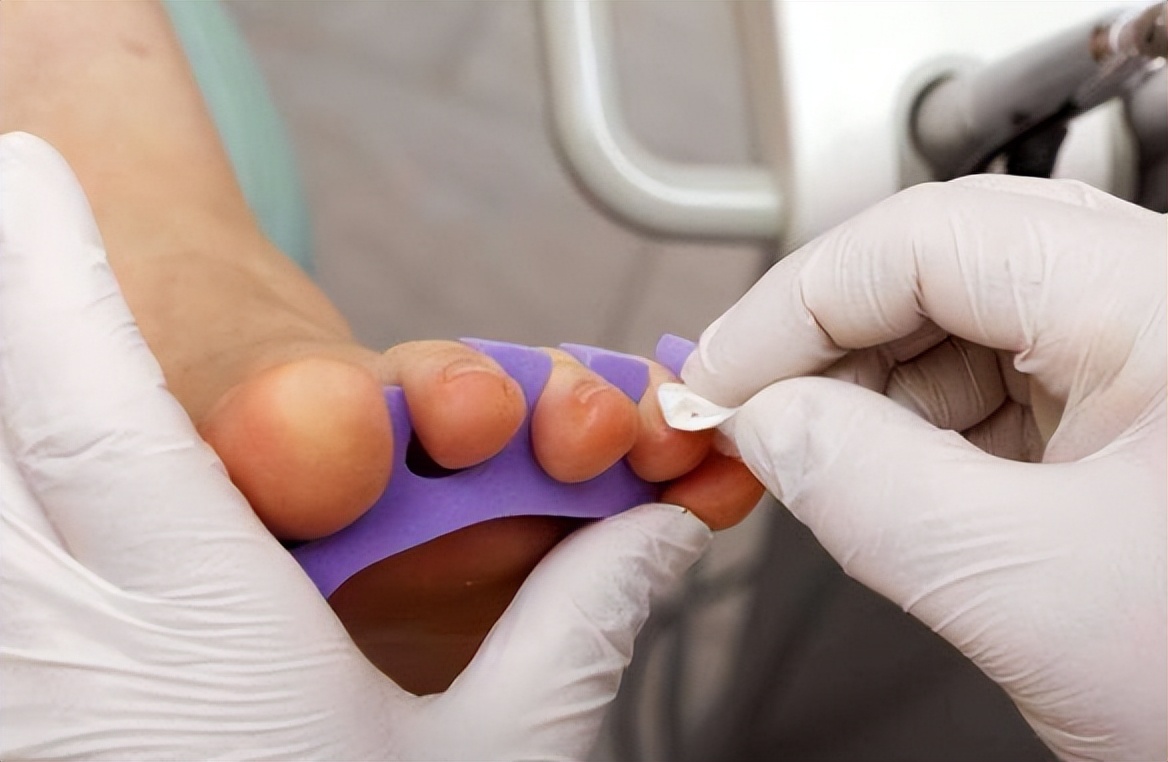 为什么有的人小脚趾指甲是一坨,小脚趾分两半的人究竟什么来历